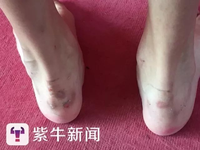 吴怡两只脚的脚后跟上有好几处皮都磨破了