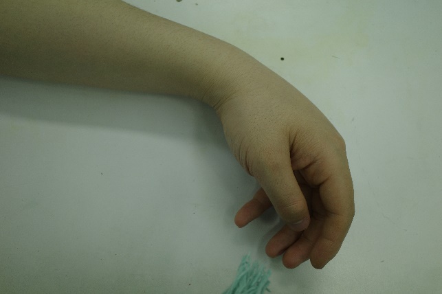 警惕，上肢剧痛，小心神经已经变成“腊肠”