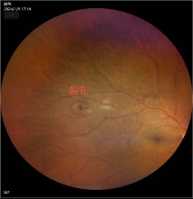 眼前黑影飘动就是飞蚊症湖北普瑞眼科专家提醒当心视网膜裂孔在作祟