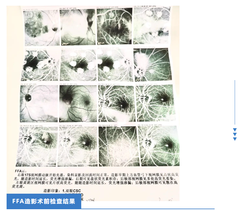 王卫星院长警惕中心性浆液性视网膜脉络膜病变csc关爱眼底健康