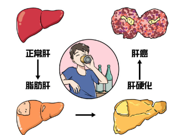 脂肪肝已成为亚健康常客laife乐轻肝守护你的健康标题