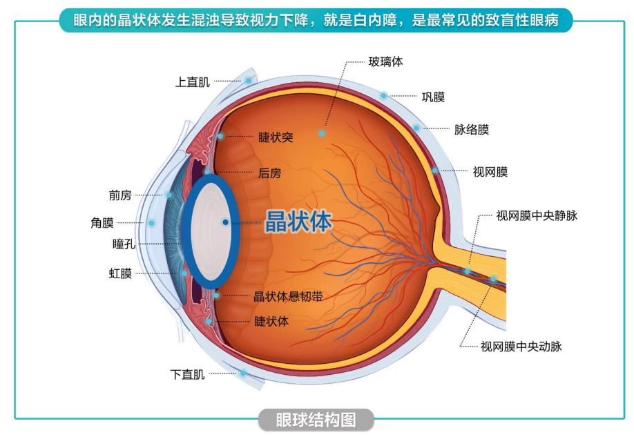 郑州爱尔眼科医生冯珂科普:你真的了解白内障吗?