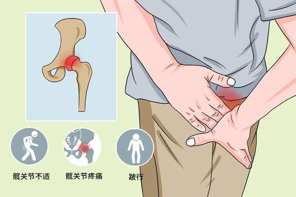 中医陈争友:素朴中医院骨科诊室独特疗法,助股骨头坏死患者重拾健康