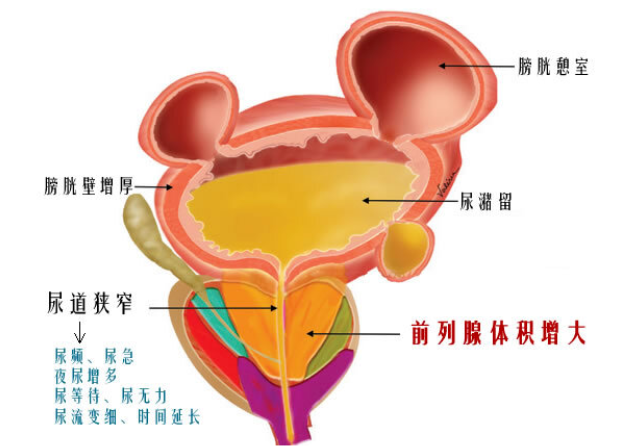 解决排尿难已经进入超微创时代 水蒸气热消融术5分钟解决前列腺增生