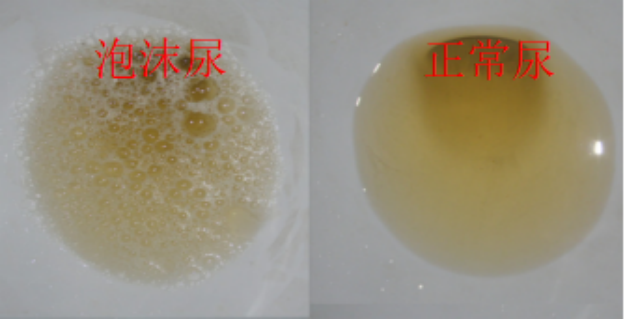 北京中医白羽医生:有了蛋白尿怎么办?