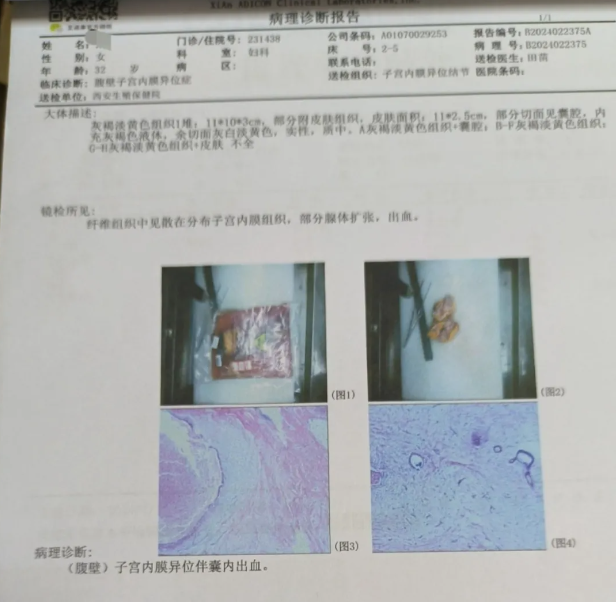 子宫内膜病理报告单图片