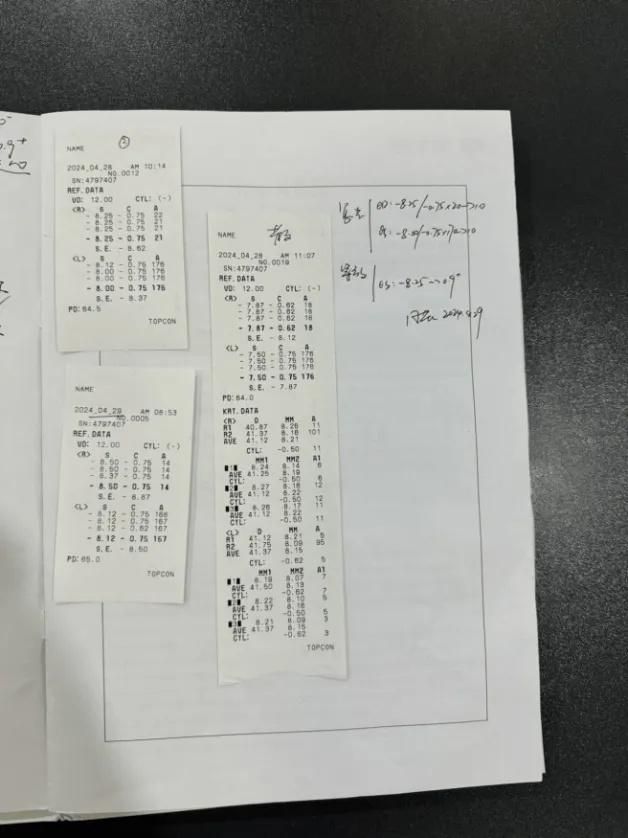 【成都icl近视手术之旅】登山教父康华在华厦眼科成功摘镜,术后双眼